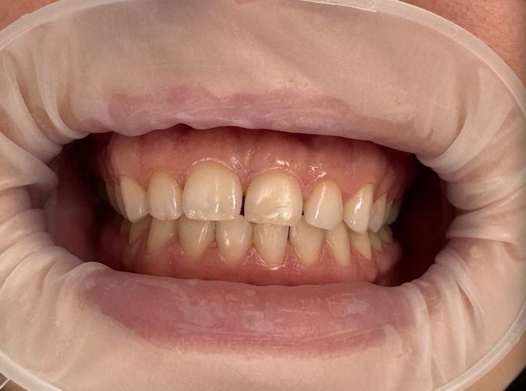 Відбілювання зубів Beyond Відбілювання зубів Beyond