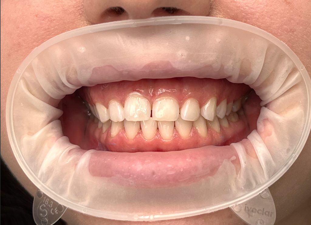 Відбілювання зубів Beyond Відбілювання зубів Beyond