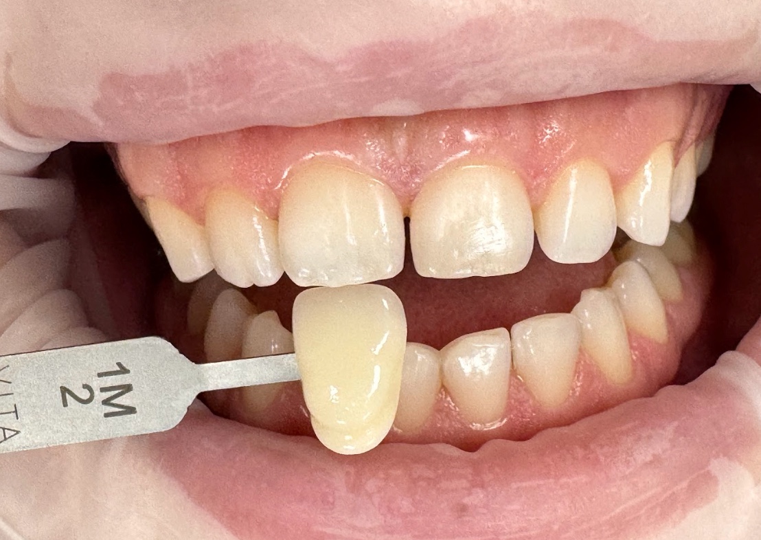 Відбілювання зубів Beyond