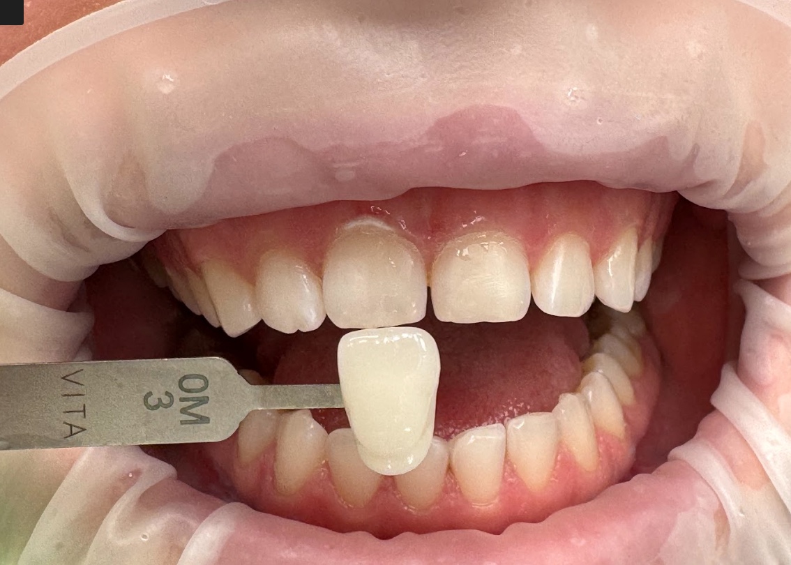 Відбілювання зубів Beyond