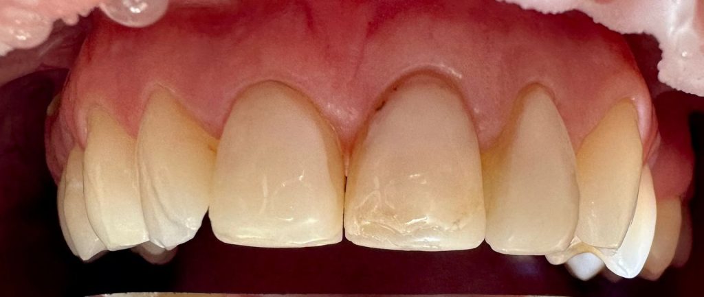 Естетична реставрація