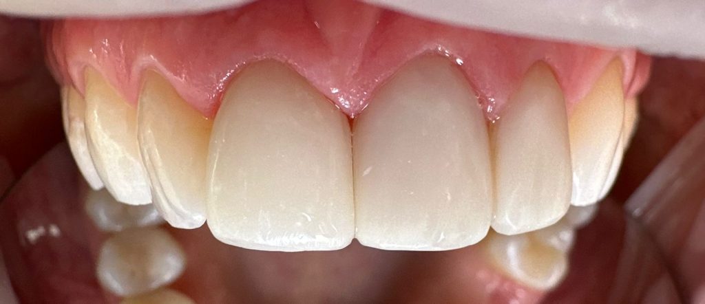 Естетична реставрація